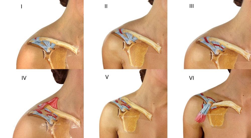 Повреждения связок плечевого сустава: причины, диагностика и лечение