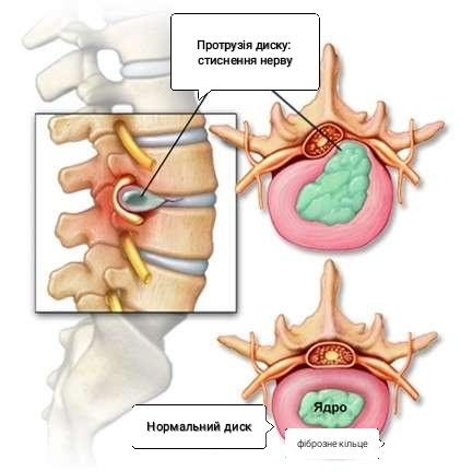 Протрузия и грыжа межпозвонкового диска